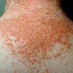 Pustular-psoriasis-500×310