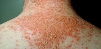 El paseo de las Explanadas acogerá del miércoles al viernes una exposición sobre la Psoriasis